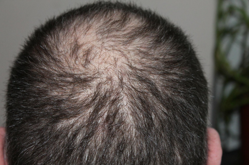 Männlicher Hinterkopf mit Haarausfall