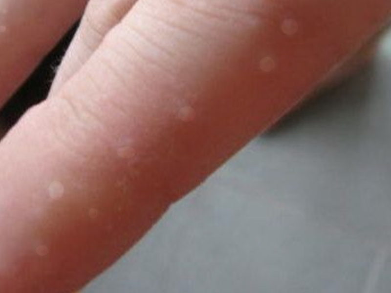 Finger mit kleinen Bläschen auf der Haut