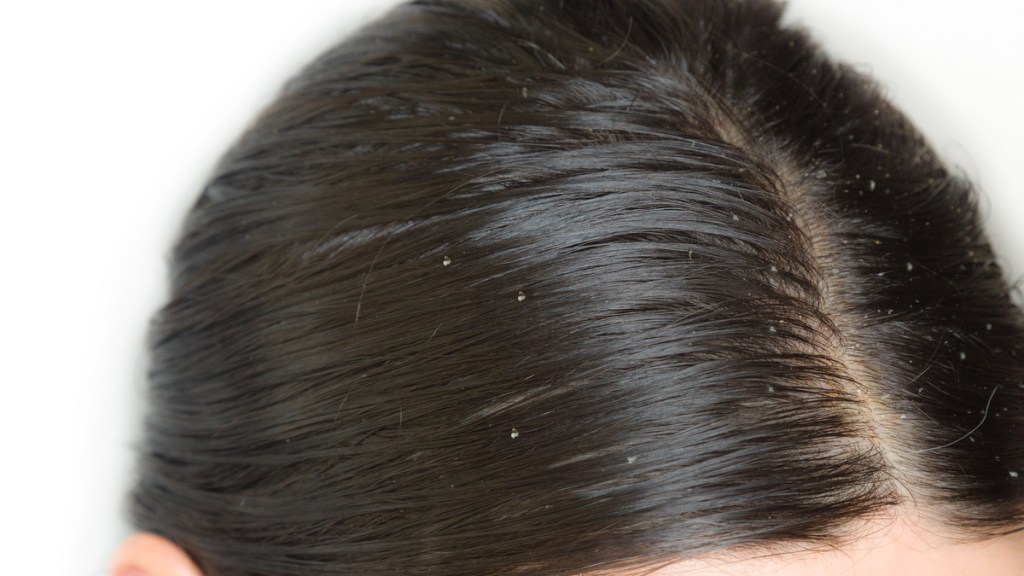 Eine Nahaufnahme eines Kopfes mit dunklen, fettigen Haaren.