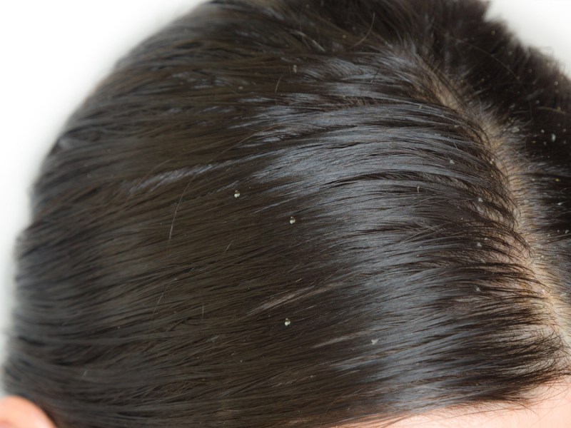 Eine Nahaufnahme eines Kopfes mit dunklen, fettigen Haaren.