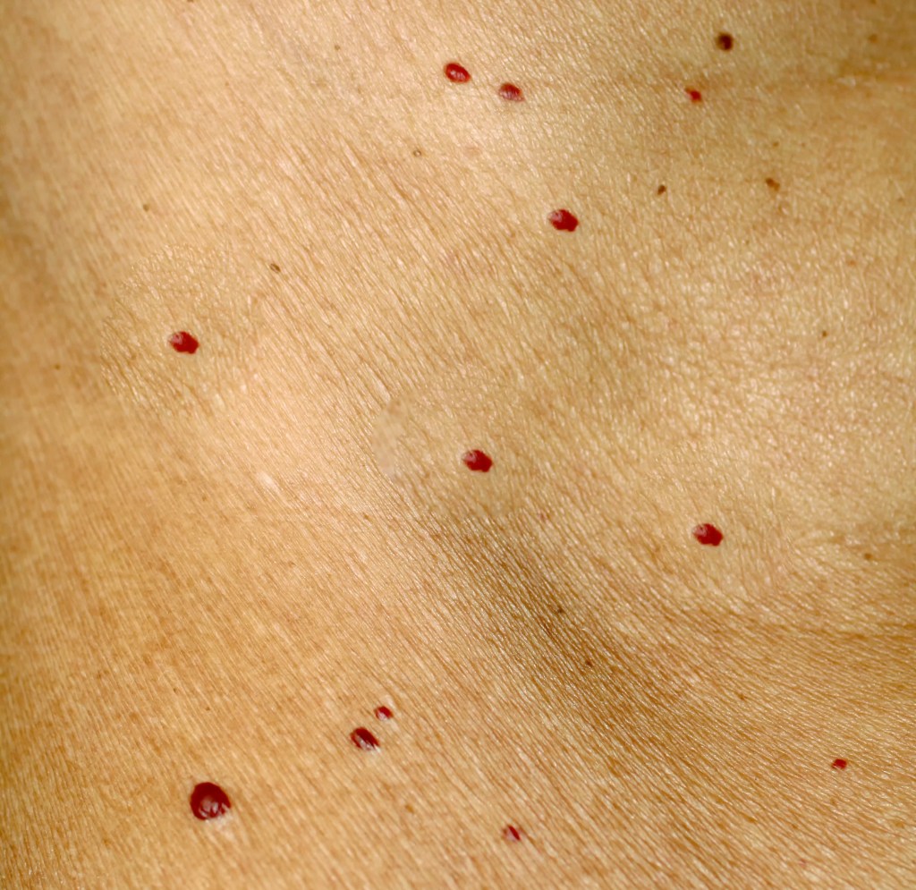 Mehrere rote Flecken auf der Haut.