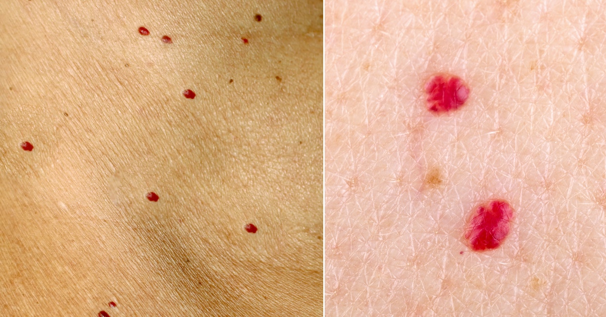 Rote Punkte auf der Haut Sind sie gefährlich oder harmlos? Genialetricks