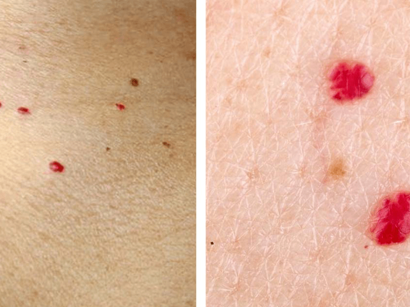 Rote Punkte auf der Haut: Sind sie gefährlich oder harmlos?
