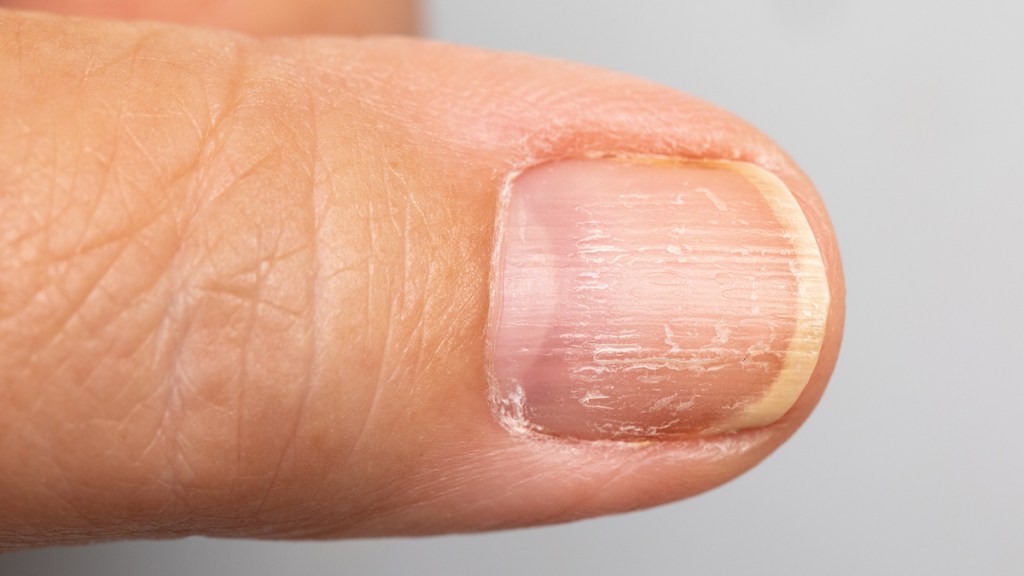 Brüchige Fingernägel können auf ein Darmproblem hindeuten.