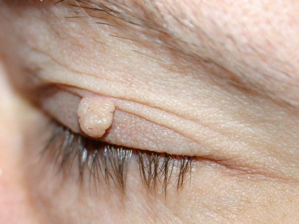 Weiches Fibrom am Auge