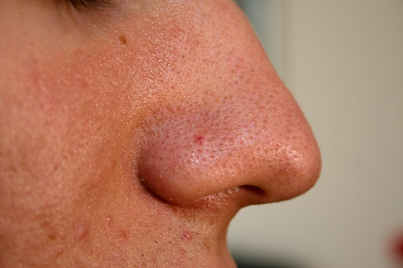 Eine Nahaufnahme zeigt die Nase einer Person. Das Hautbild wird durch Mitesser und groÃŸe Poren beeintrÃ¤chtigt.