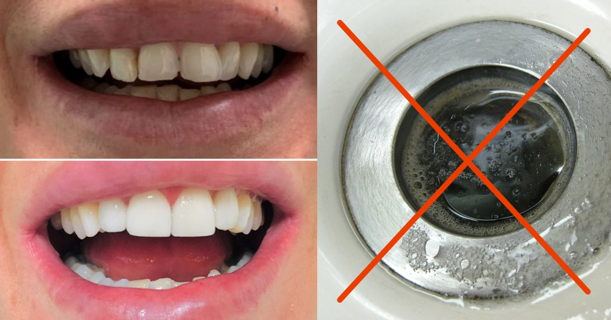 Links im Bild: Zwei geÃ¶ffnete MÃ¼nder mit ZÃ¤hnen untereinander; oben: trÃ¼be Zahnfarbe; unten: strahlend weiÃŸe ZÃ¤hne. Rechts im Bild: ein mit einem roten Kreuz durchgestrichener Abfluss