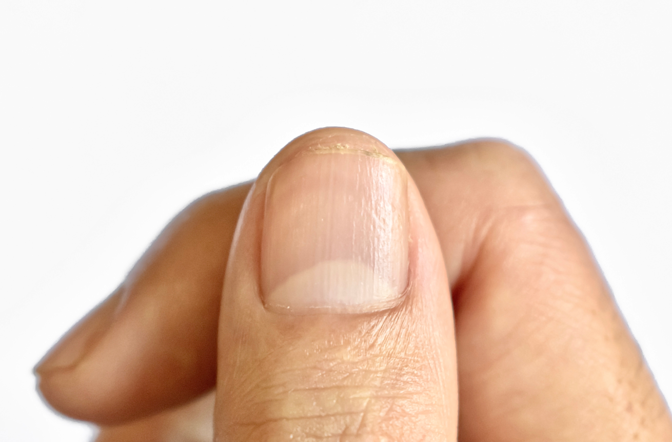 Ein Fingernagel, bei dem die Lunula gut ausgeprÃ¤gt ist. Der weiÃŸe Halbmond gibt Aufschluss Ã¼ber die Gesundheit.
