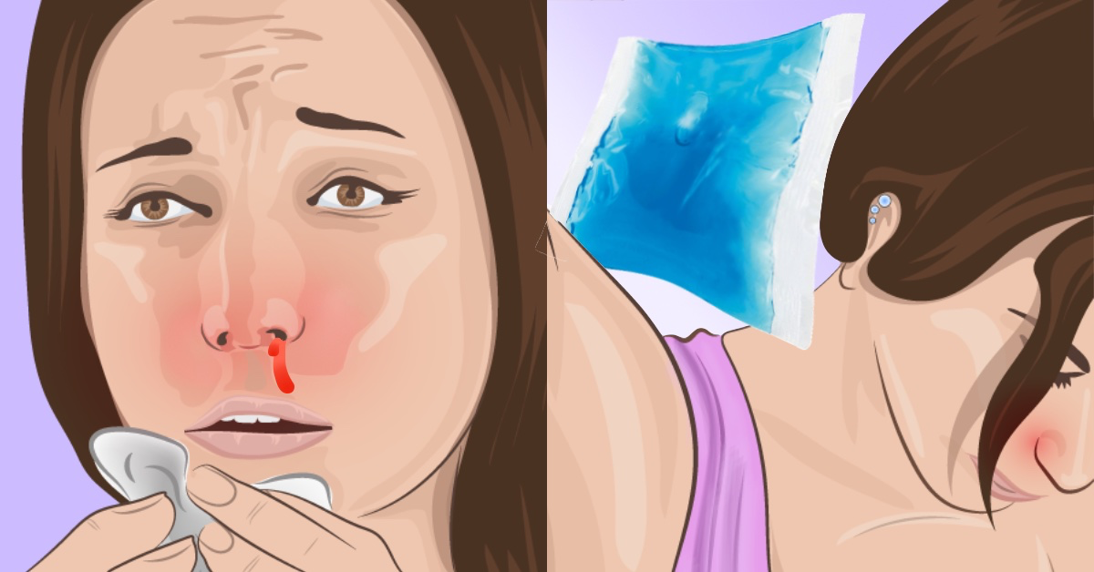 Kopf hochlagern, den Nacken kühlen und die Nasenflügel zusammenpressen, das sind die besten Tipps zum Nasenbluten-Stoppen.