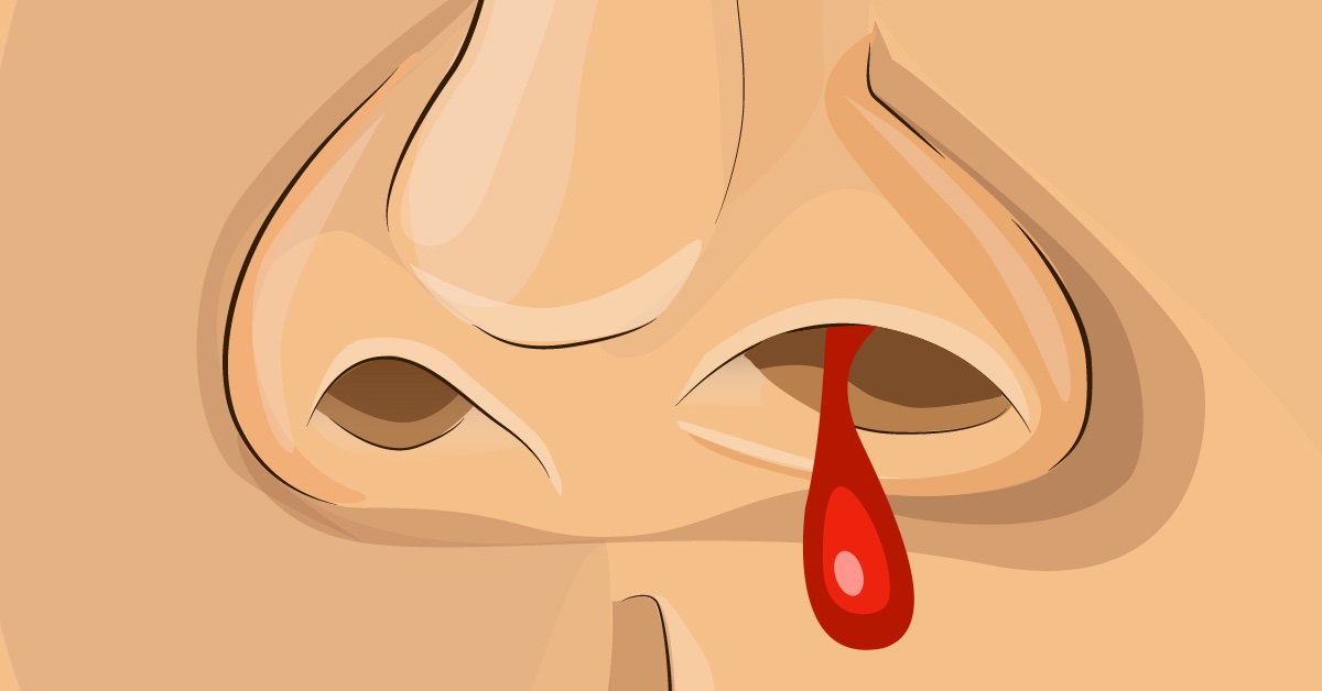 Nasenbluten stoppen: Mit diesen Tipps gehst du auf Nummer sicher.