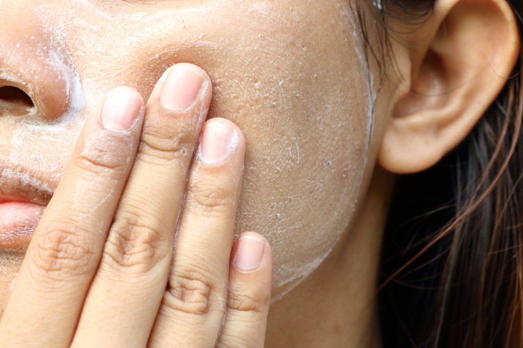 Pickelmale entfernen Um Pickelmale zu entfernen, kannst du regelmäßig eine Maske aus Joghurt und Zitronensaft auftragen.
