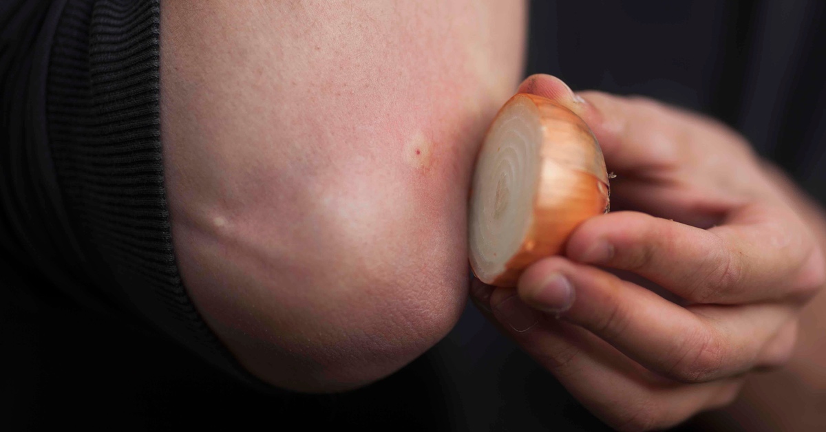 Wespenstich wird mit einer Zwiebel behandelt.