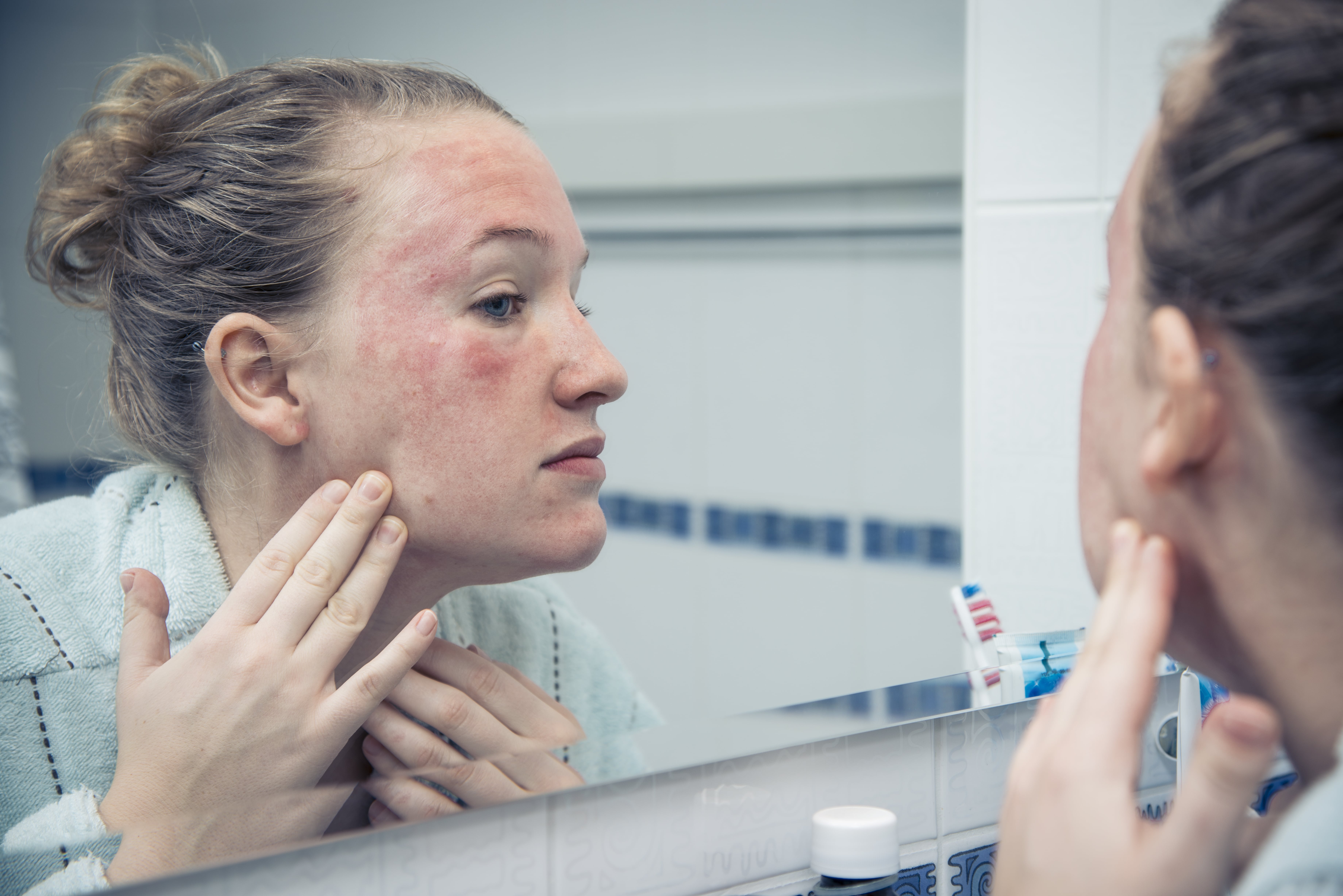 Frau mit Ausschlag im Gesicht guckt in einen Spiegel 