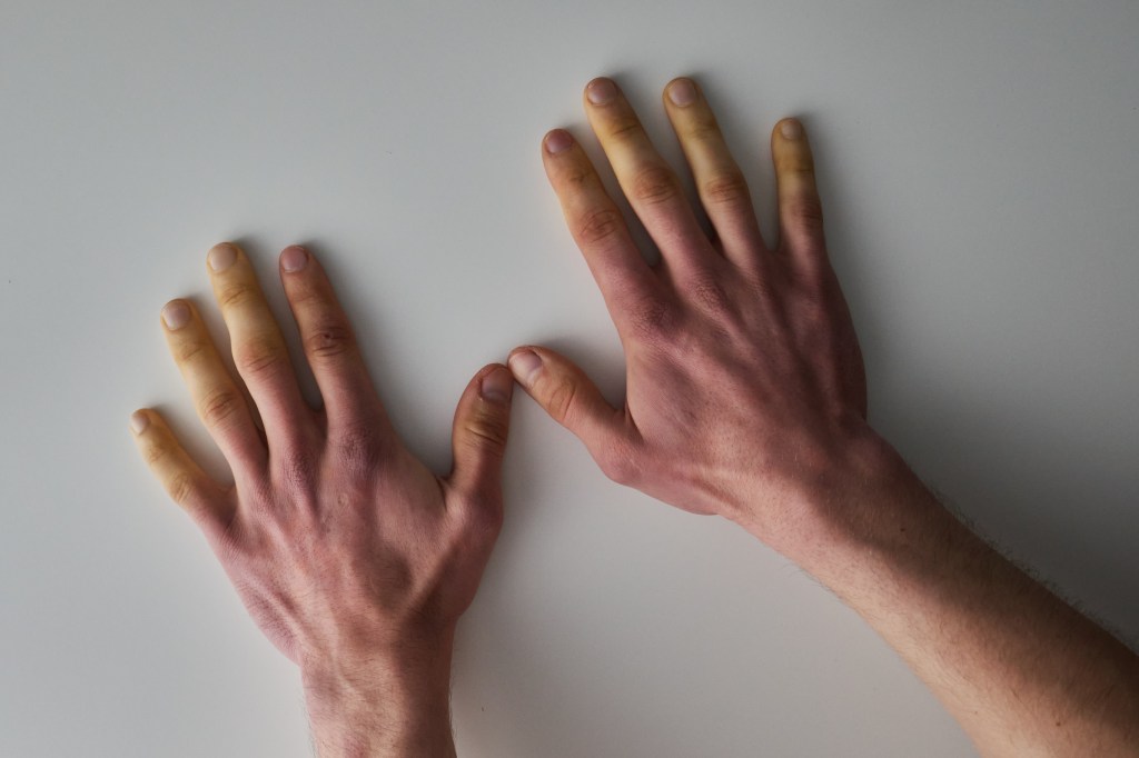 Raynaud-Syndrom an beiden Händen.
