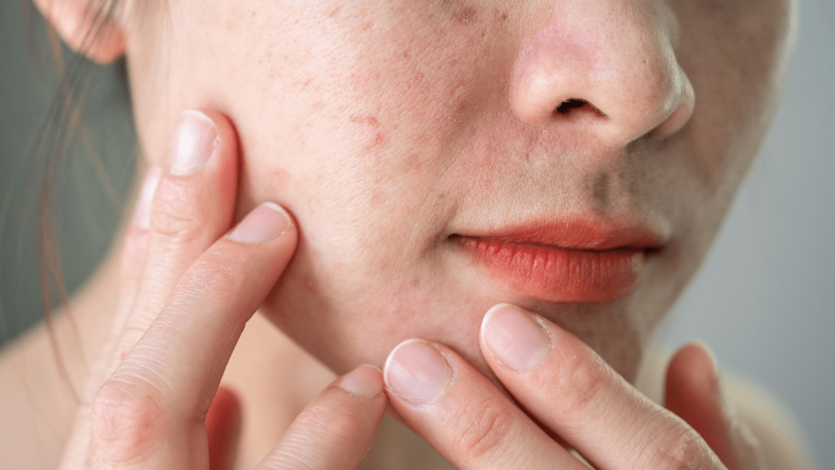 Frau mit Hautausschlag im Gesicht
