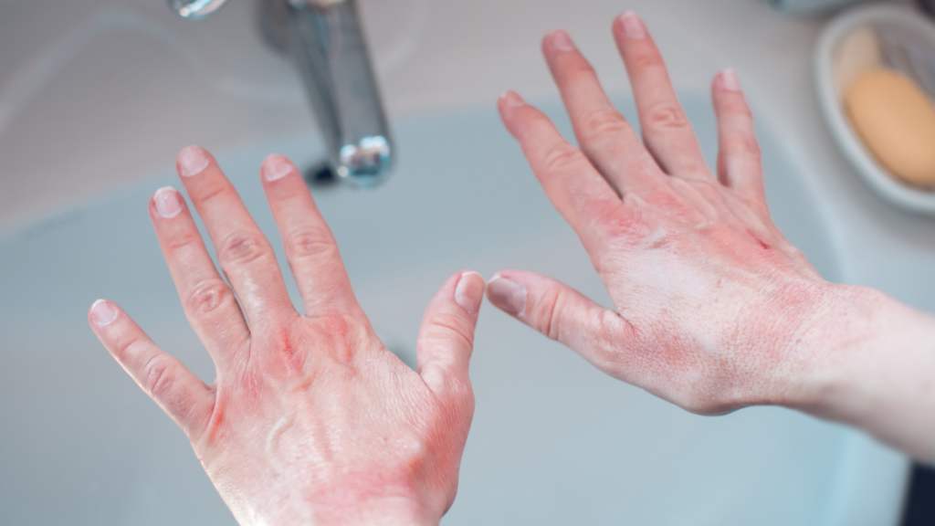 Hautirritationen an den Händen