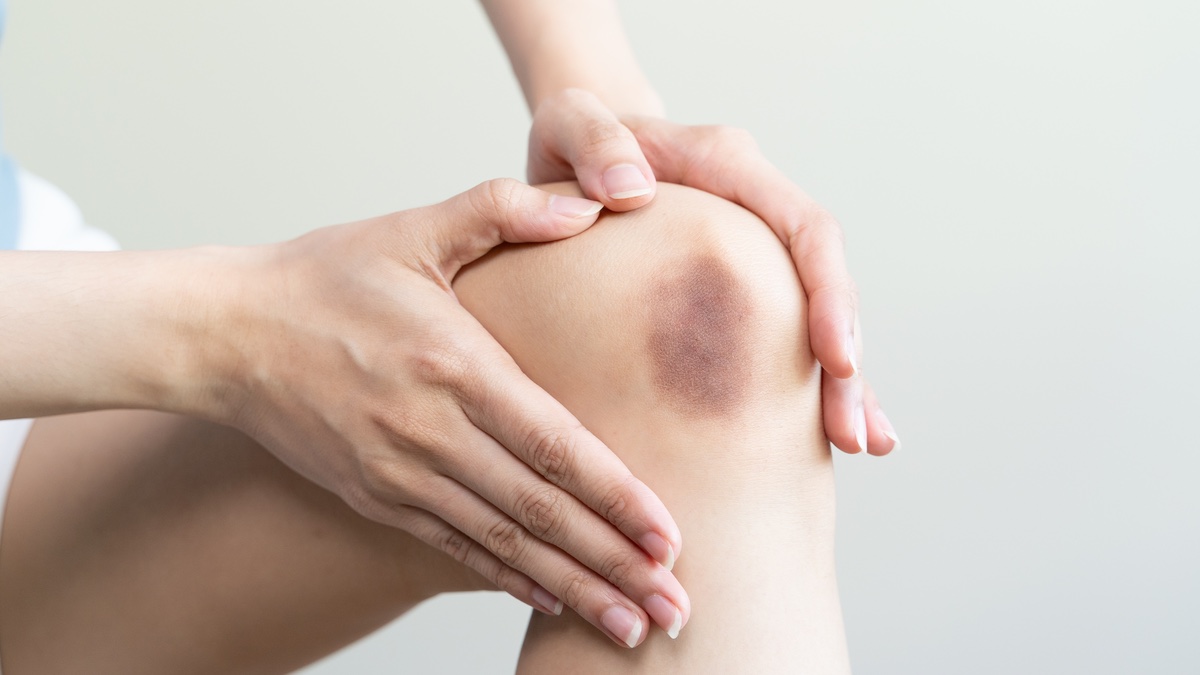 Blauer Fleck am Knie.