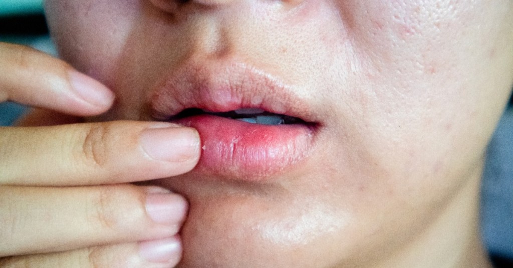 Nahaufnahme eines Mundes mit trockenen, geröteten Lippen