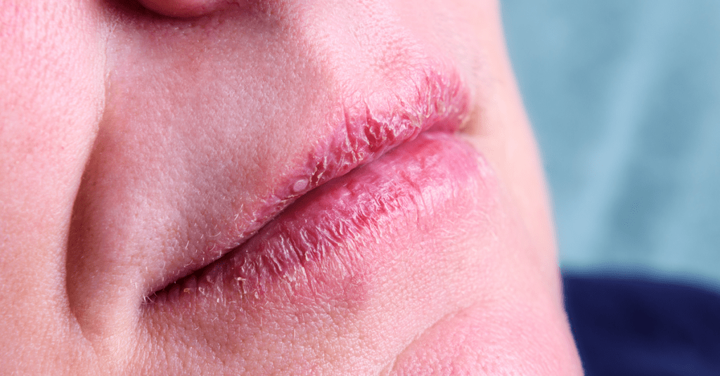 Trockene Lippen 